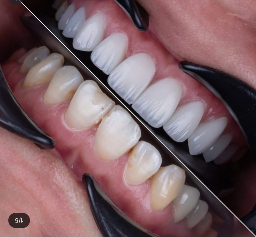 Why we are the Best Hollywood Smile Dental Clinic